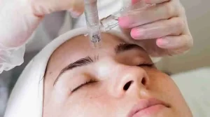 Is Microneedling After Botox Above Eyes Safe?