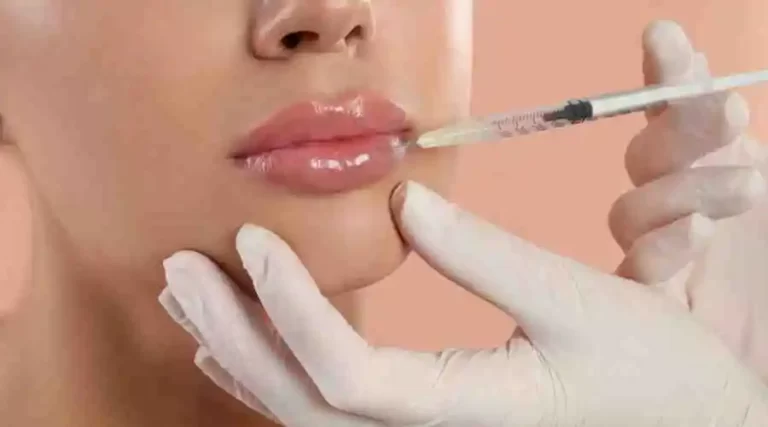 5 Things to Know About Lip Injections and Lip Filler: